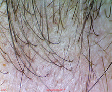 Firefly DE300 Digital Dermatoscope for skin examination