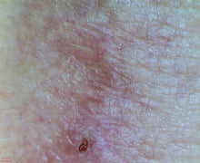 DE300 dermatoscope HD Camera capturing detailed magnified skin images for clinical diagnosis and patient assessment