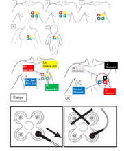 MRI ECG ezPadMRI 4 – ECG Electrode Dots (30mm)